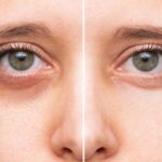 How to Prevent, Avoid, and Cure Dry Eyes Permanently