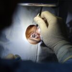 Is LASIK Surgery Safe